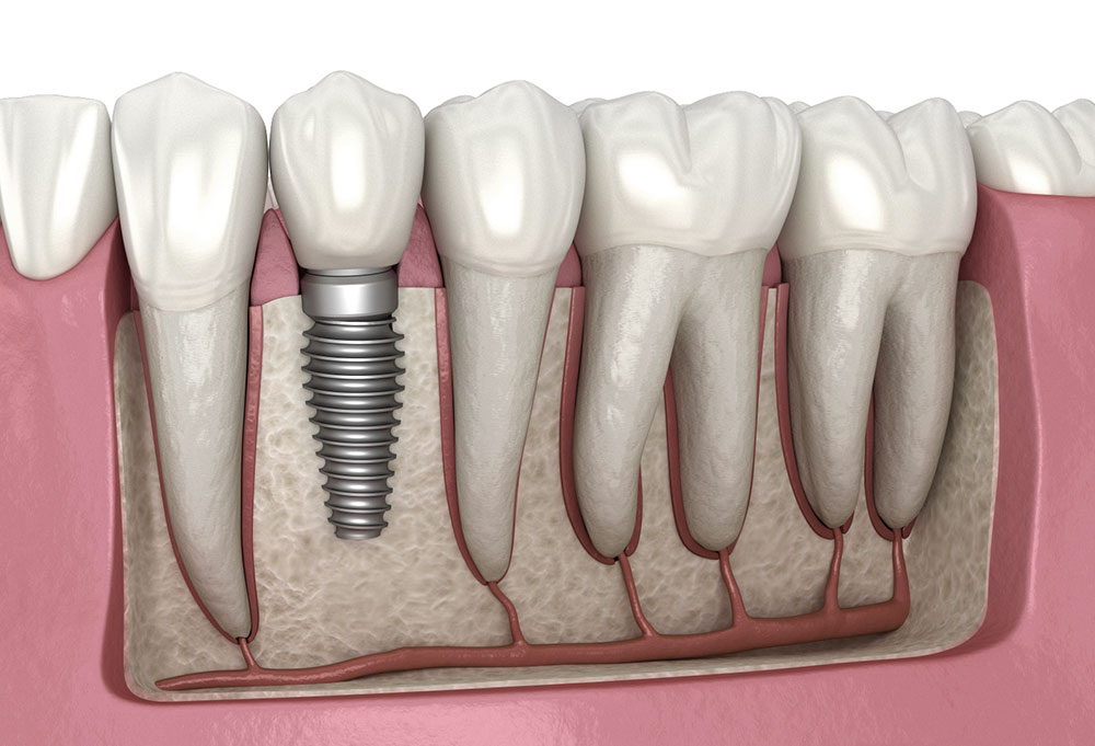 Trồng răng Implant