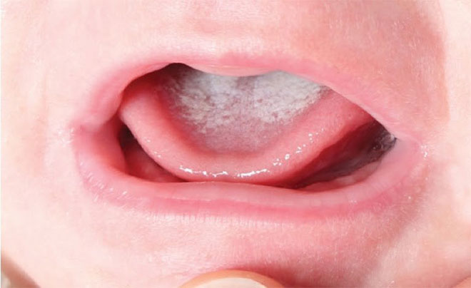Hướng dẫn cách vệ sinh miệng cho trẻ sơ sinh
