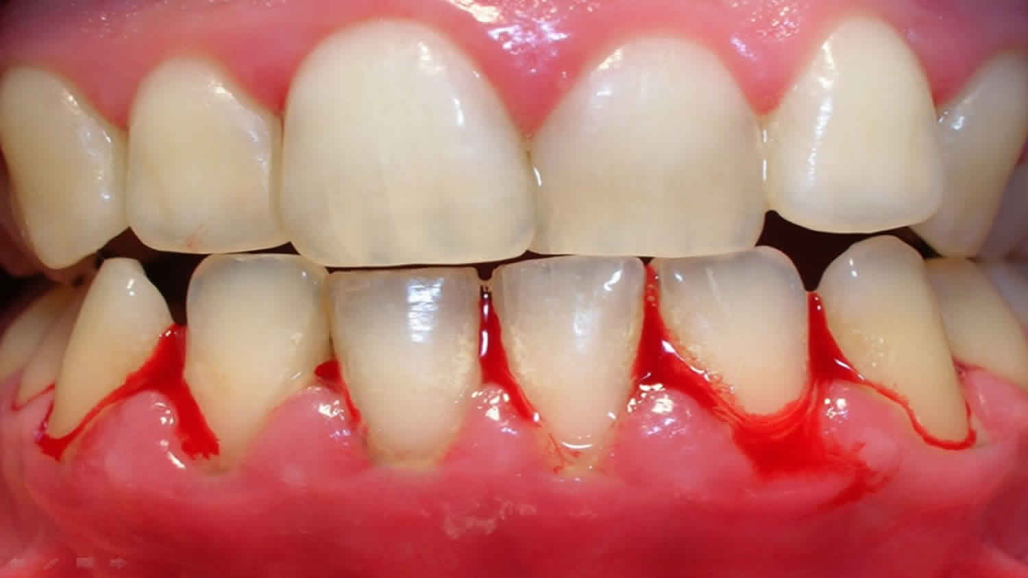 Mẹo chăm sóc sau khi phẫu thuật nha khoa
