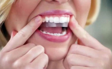 Làm trắng răng kéo dài bao lâu?