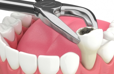 Điều gì sẽ xảy ra với việc nhổ răng