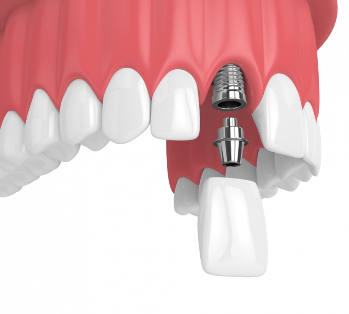 Dịch vụ Trồng Răng Implant